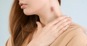 Vết hickey là gì? Hướng dẫn các cách xóa hickey an toàn tại nhà