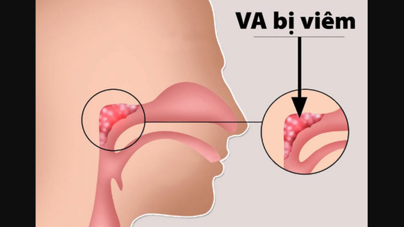 viêm va là gì 1