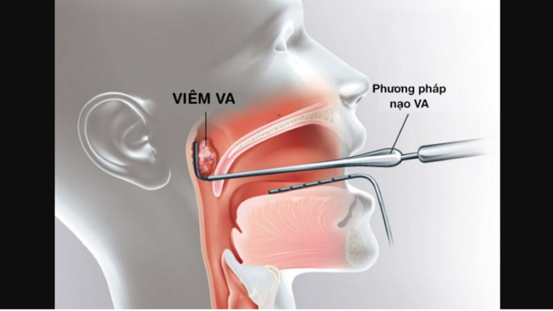 viêm va là gì 3
